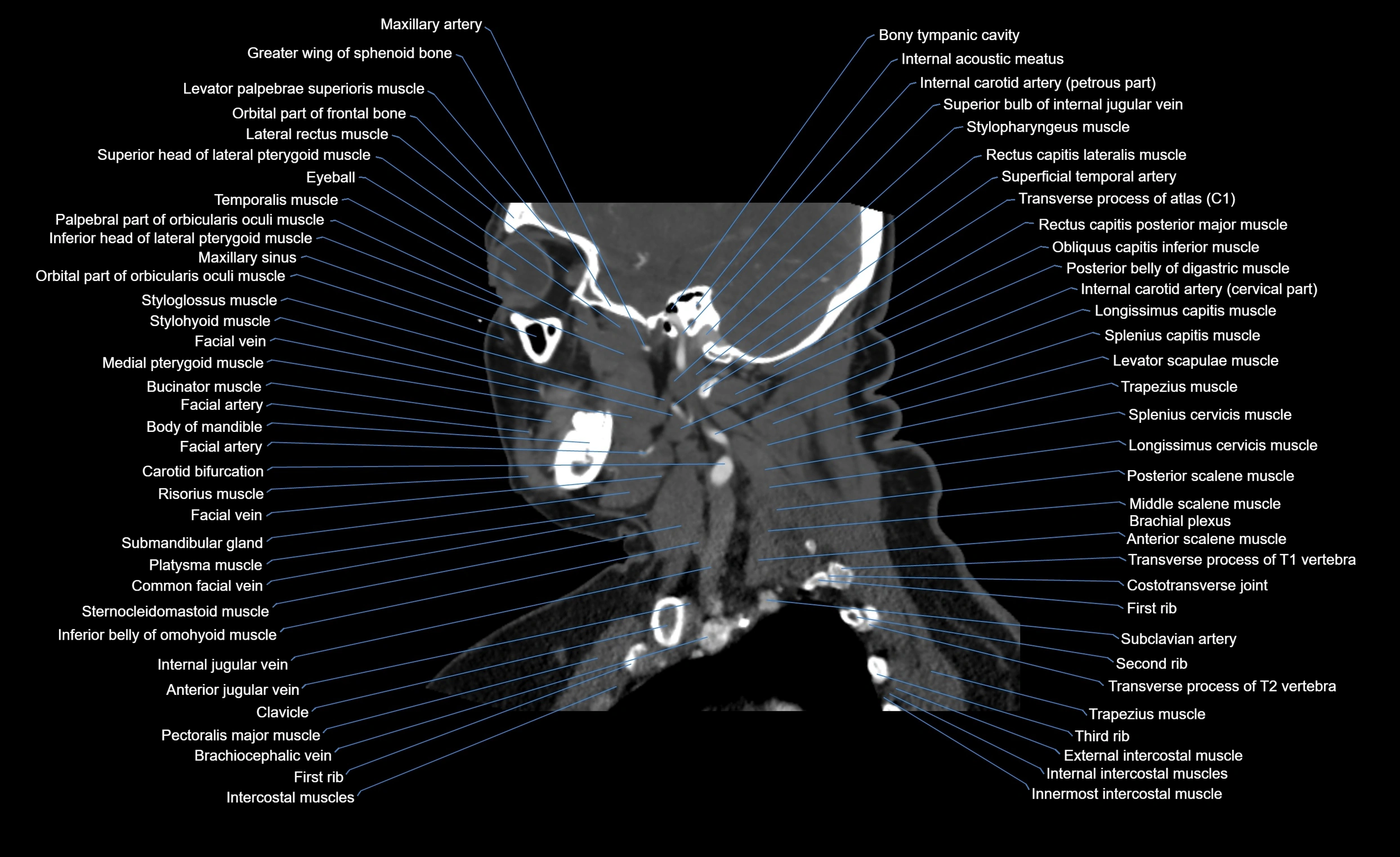 Neck CT sagittal cross sectional anatomy 3D  radiology  image-img-00001-00012.webp